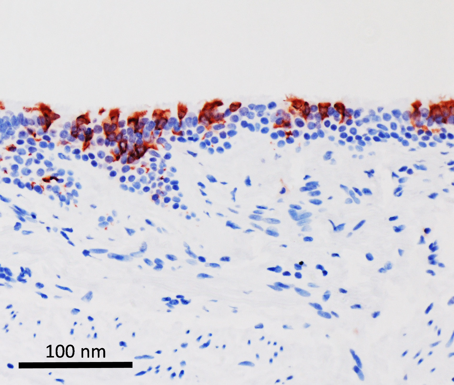 Omicron variant of SARS-CoV-2 (in red) infected human bronchus tissues.