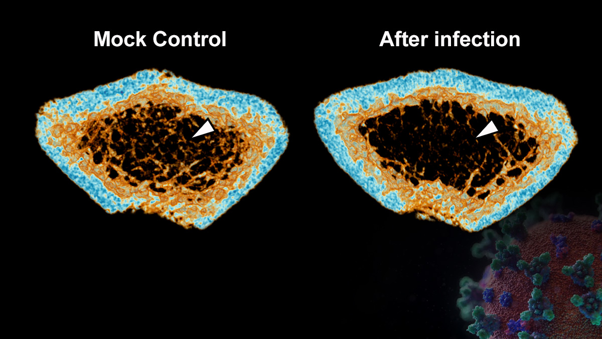 SARS-CoV-2 infection induces continuous inflammatory bone loss during both the acute and post-recovery phases of COVID-19