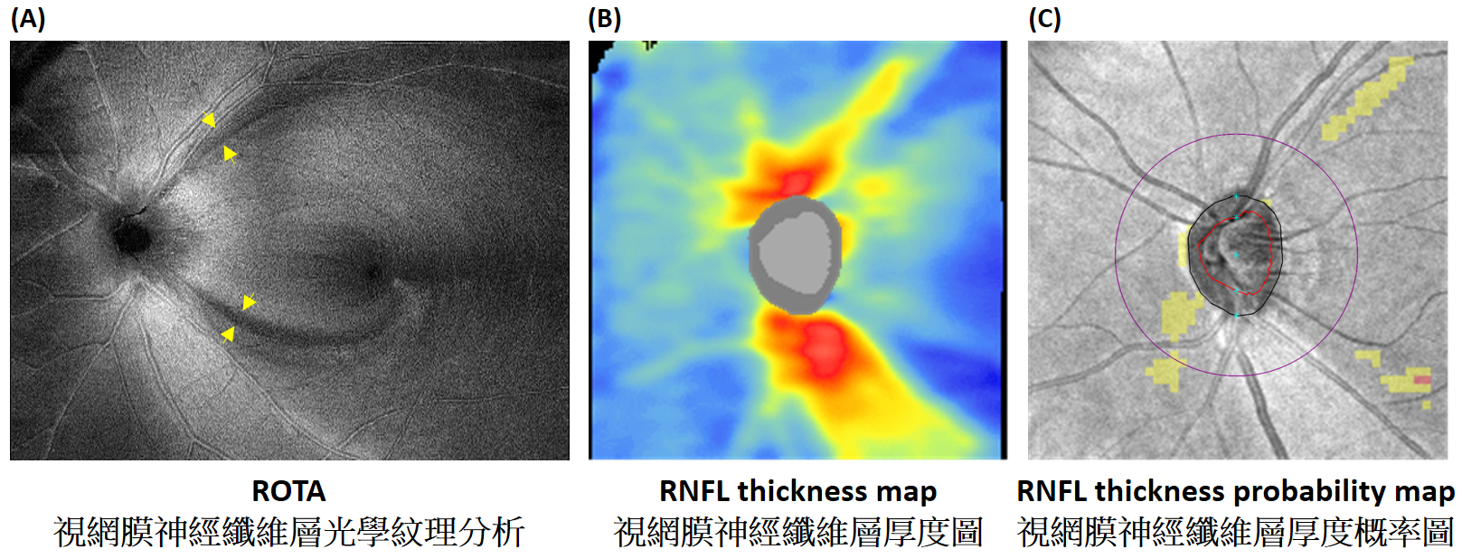 HKUMed and CU Medicine have developed the new technology ROTA that can unveil the optical texture and trajectories of the axonal fibre bundles on the retina.