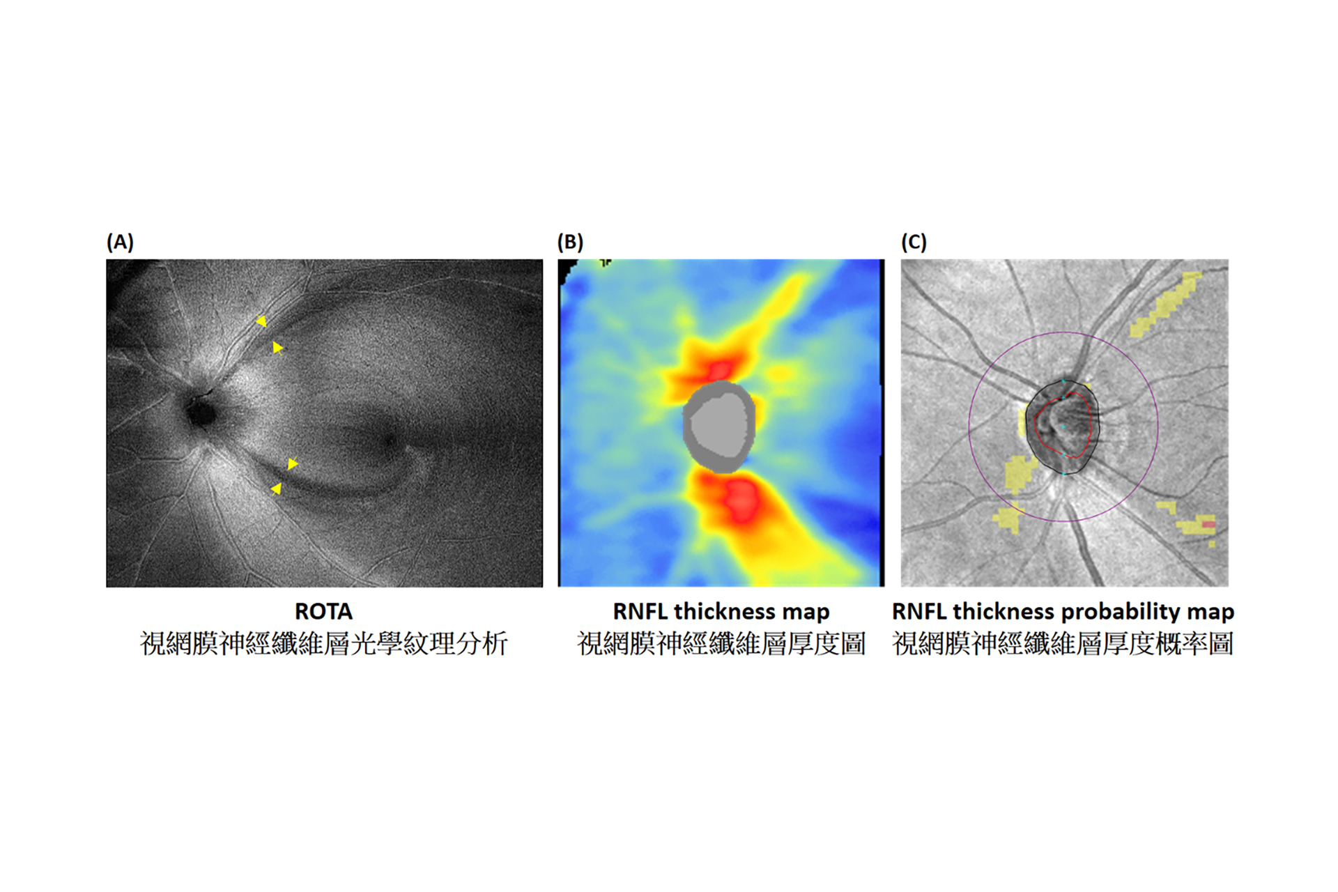 HKUMed and CU Medicine have developed the new technology ROTA that can unveil the optical texture and trajectories of the axonal fibre bundles on the retina.